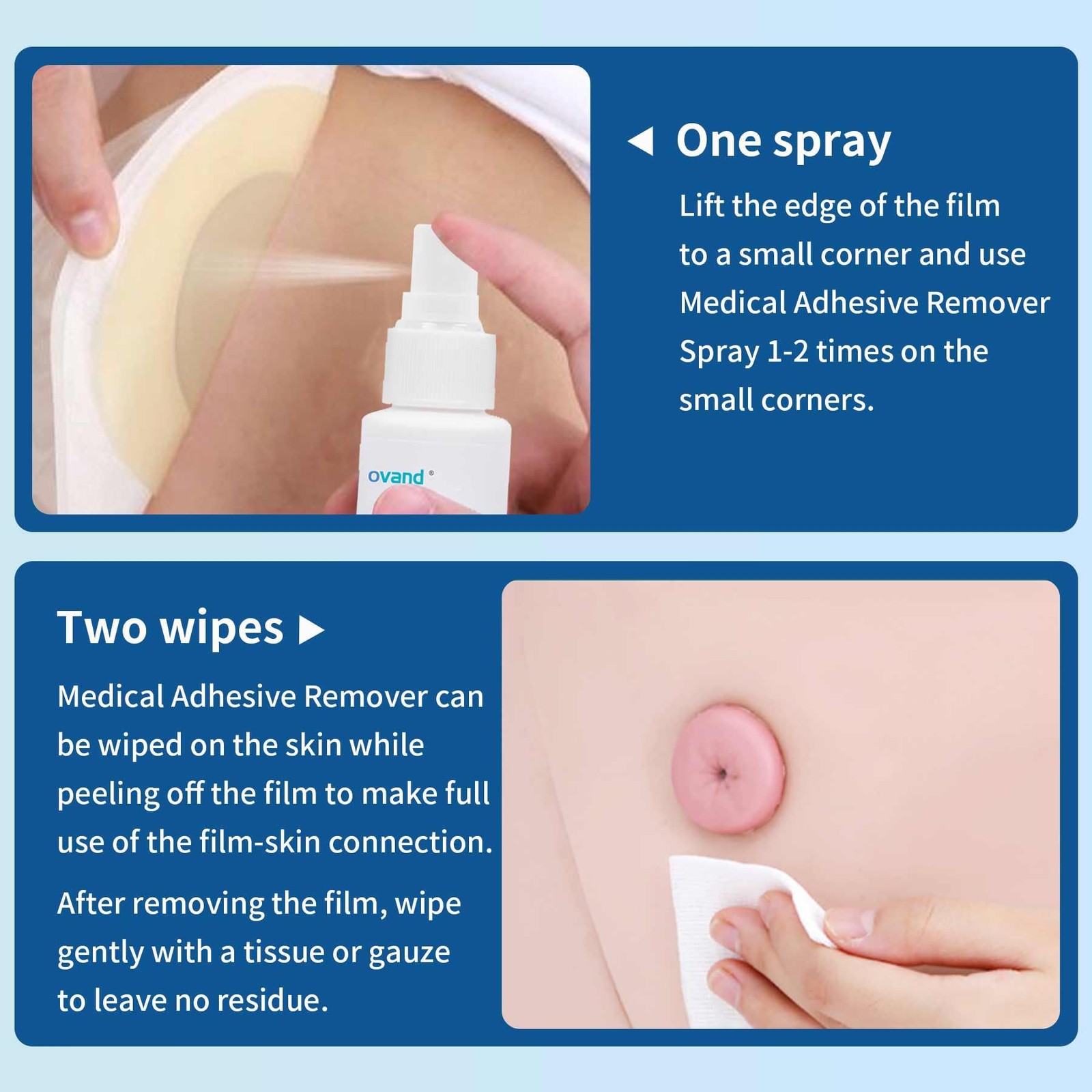 No-Sting Ostomy Adhesive Remover Spray 4 Pack 1oz Skin Mastectomy Tape Medical